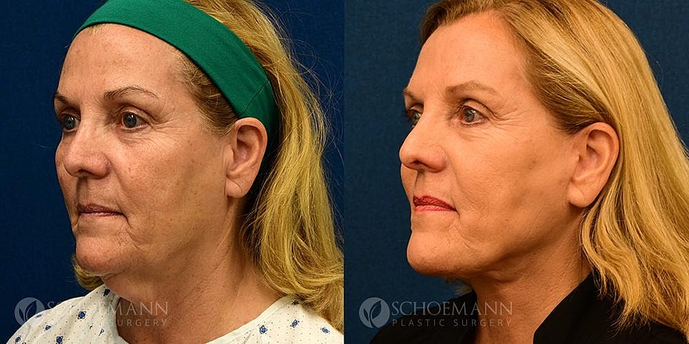 Facelift Before & After
