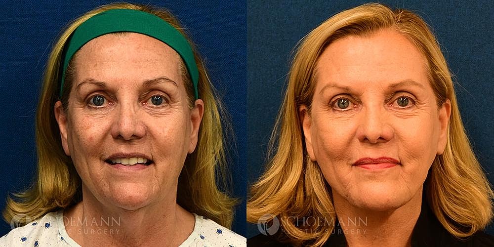 Facelift Before & After