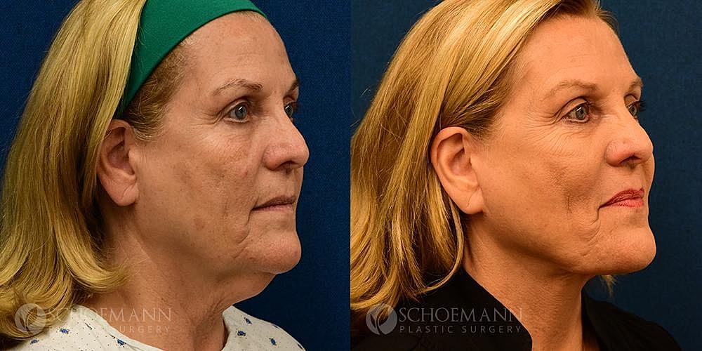 Facelift Before & After