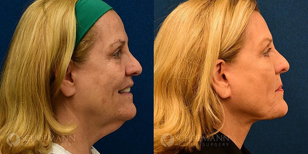 Facelift Before & After