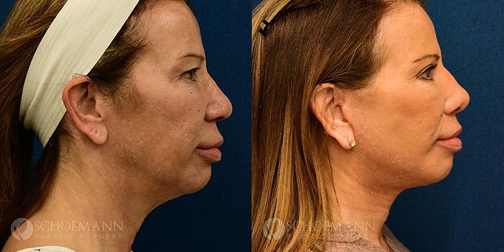 Facelift Before & After