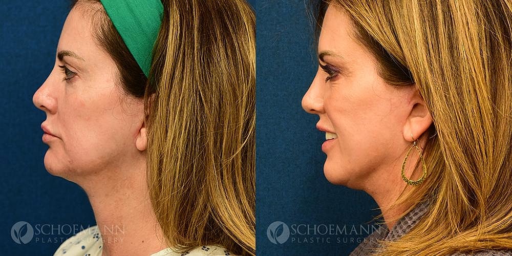 Facelift Before & After