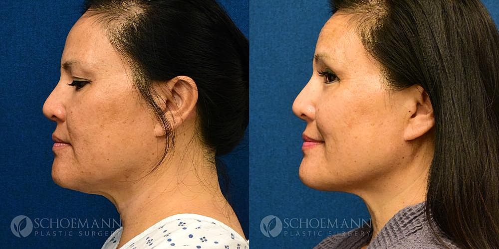 Facelift Before & After