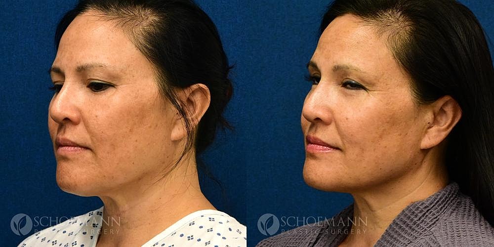 Facelift Before & After