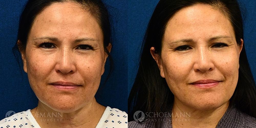 Facelift Before & After