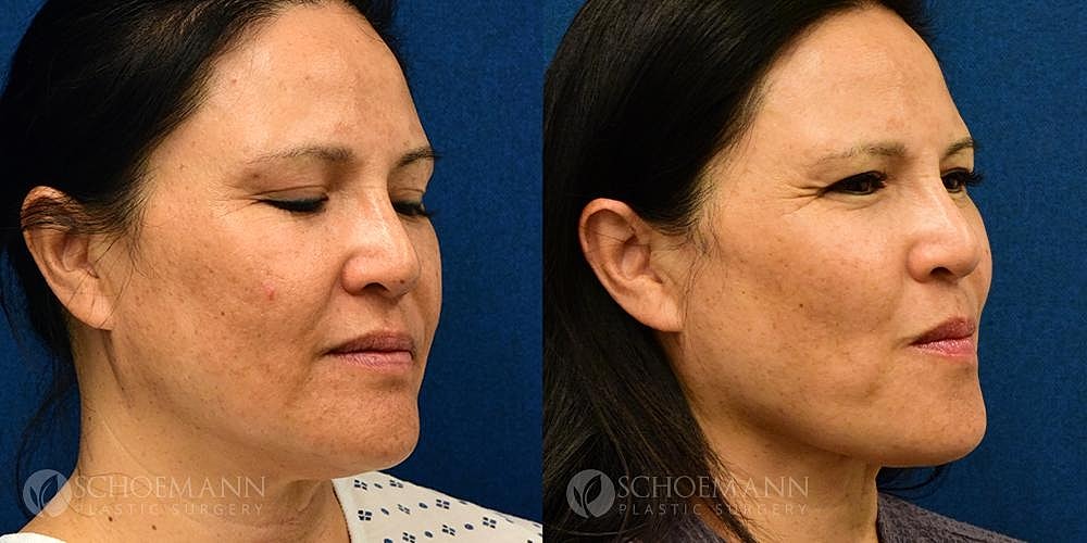 Facelift Before & After
