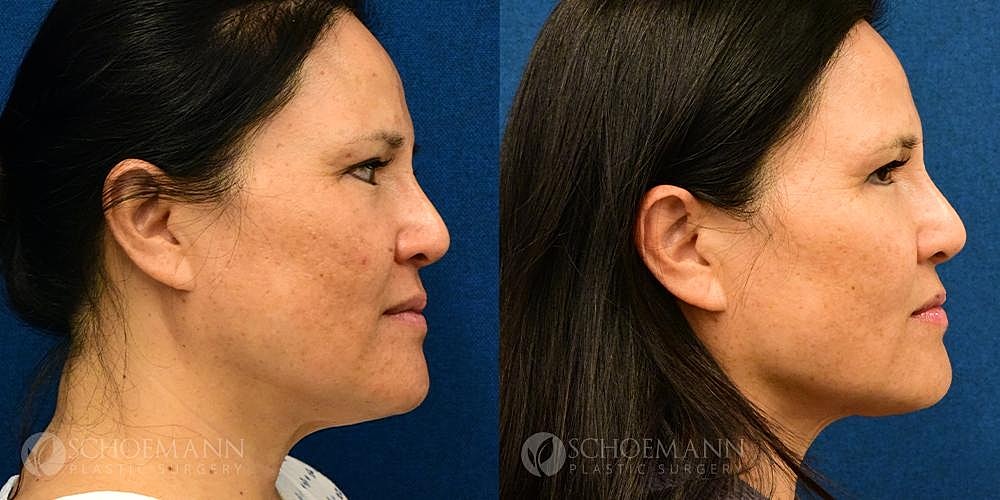 Facelift Before & After