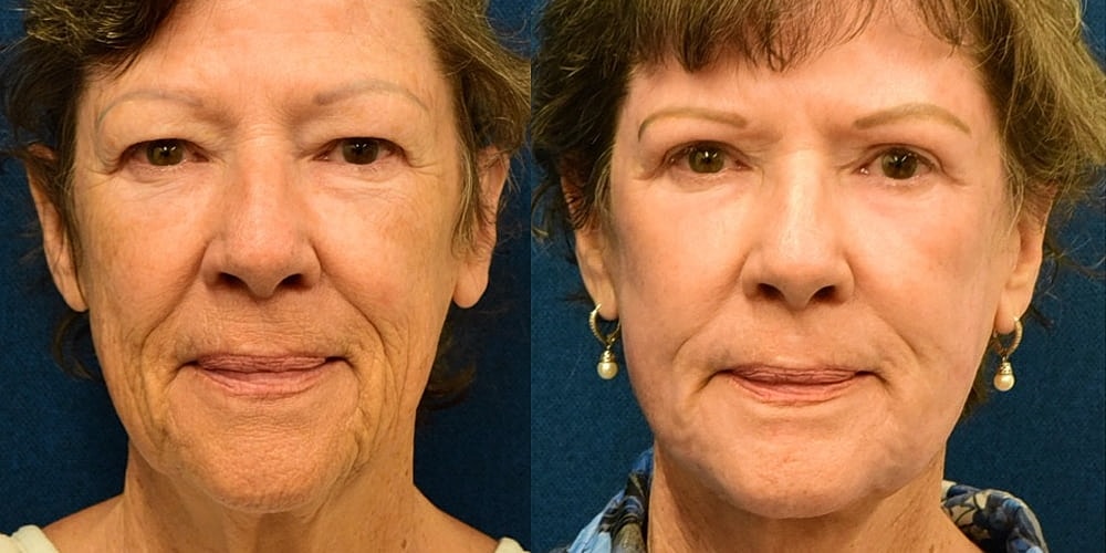 Facelift Before & After