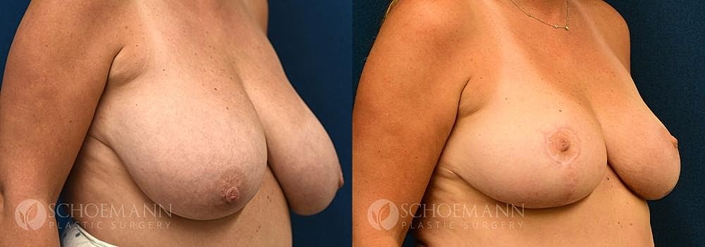 Breast Reduction Before & After