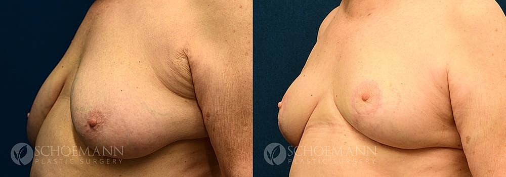 Breast Reduction Before & After