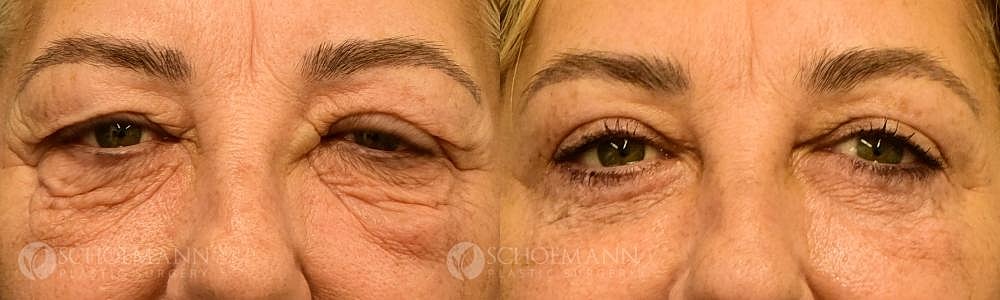 Eyelid Lift Before & After