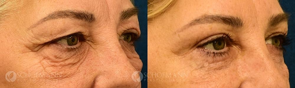 Eyelid Lift Before & After