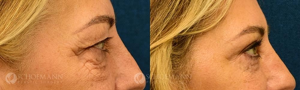 Eyelid Lift Before & After