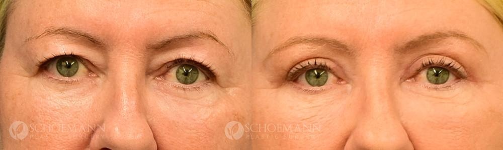 Eyelid Lift Before & After