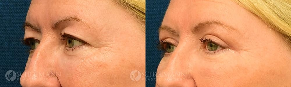 Eyelid Lift Before & After