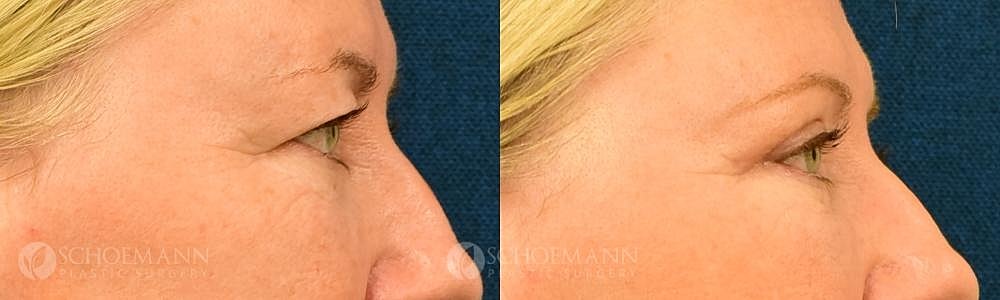 Eyelid Lift Before & After