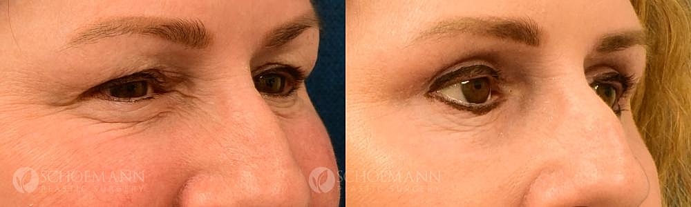Eyelid Lift Before & After