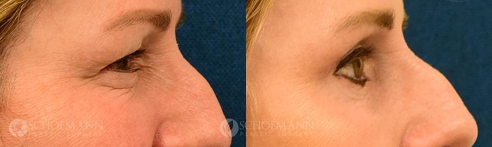 Eyelid Lift Before & After
