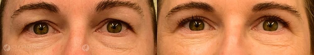 Eyelid Lift Before & After