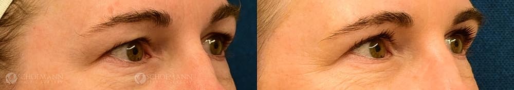 Eyelid Lift Before & After