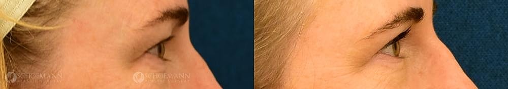 Eyelid Lift Before & After
