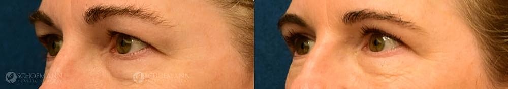 Eyelid Lift Before & After