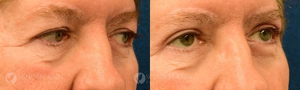 Eyelid Lift Before & After