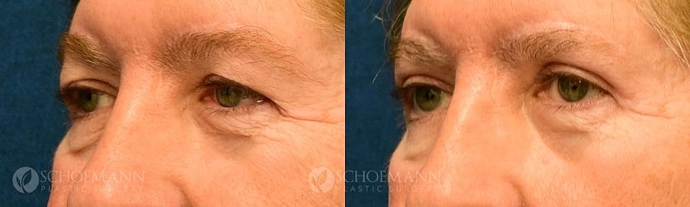 Eyelid Lift Before & After
