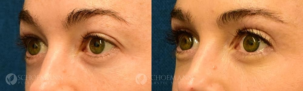 Eyelid Lift Before & After