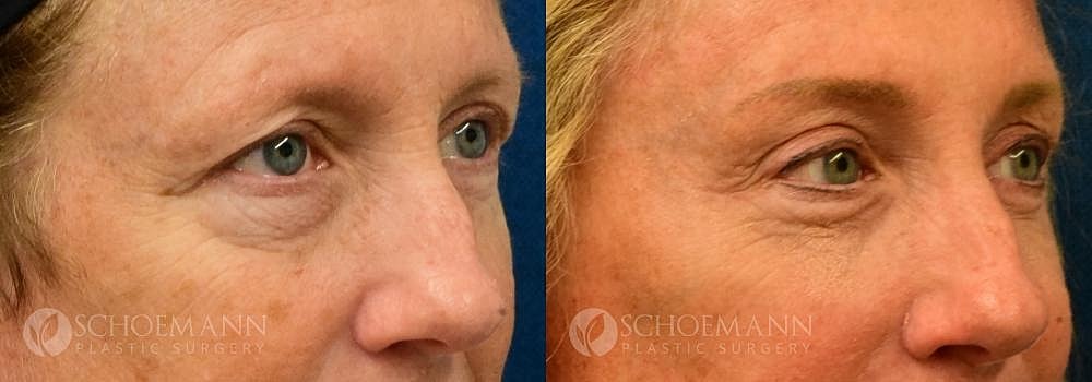 Eyelid Lift Before & After