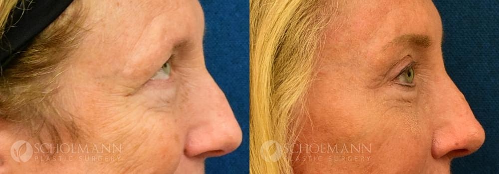 Eyelid Lift Before & After