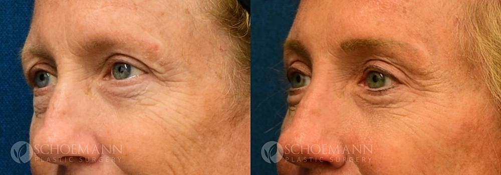 Eyelid Lift Before & After