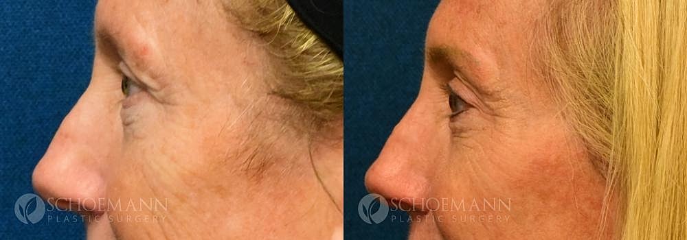 Eyelid Lift Before & After