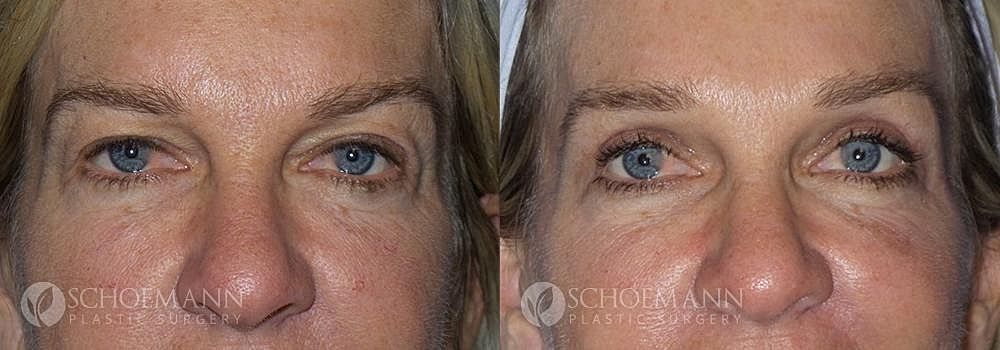 Eyelid Lift Before & After