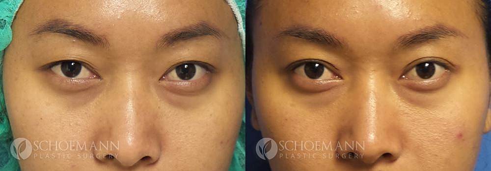 Eyelid Lift Before & After