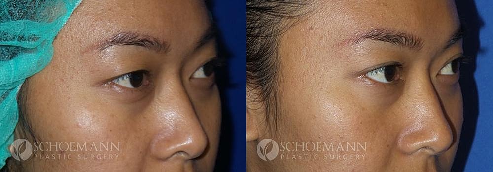 Eyelid Lift Before & After