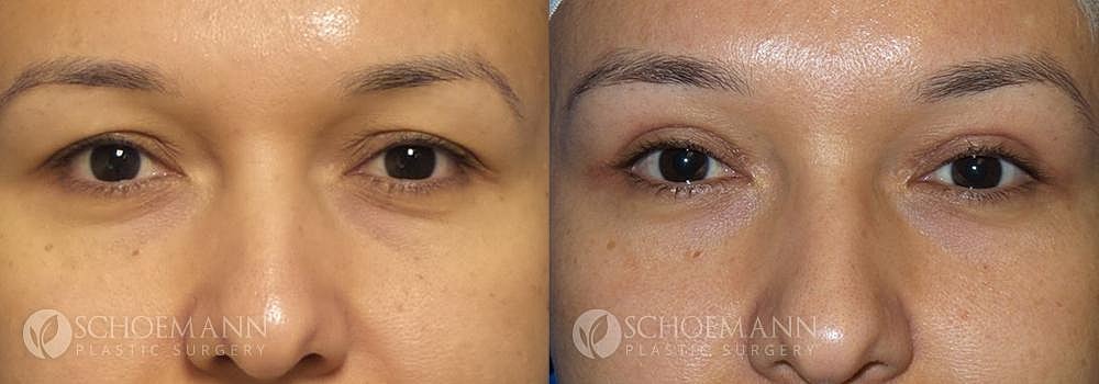 Eyelid Lift Before & After
