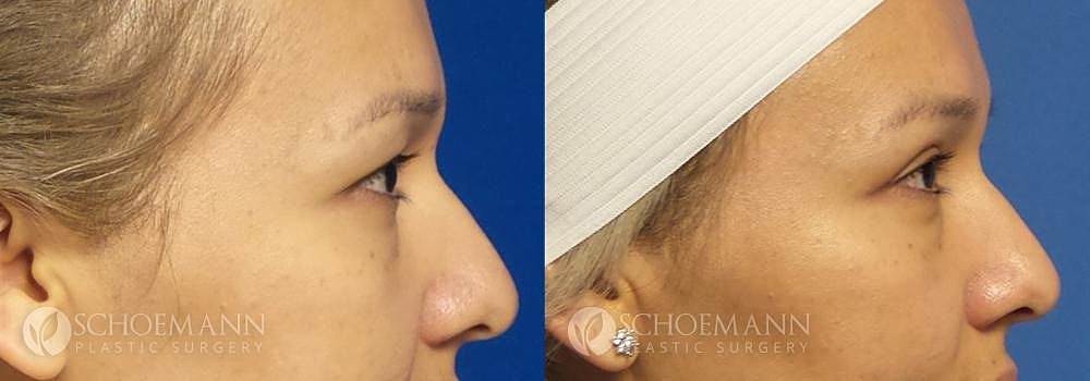 Eyelid Lift Before & After