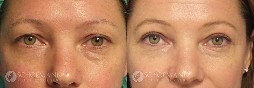 Eyelid Lift Before & After