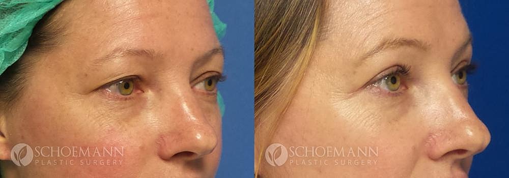 Eyelid Lift Before & After