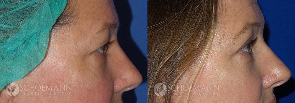 Eyelid Lift Before & After