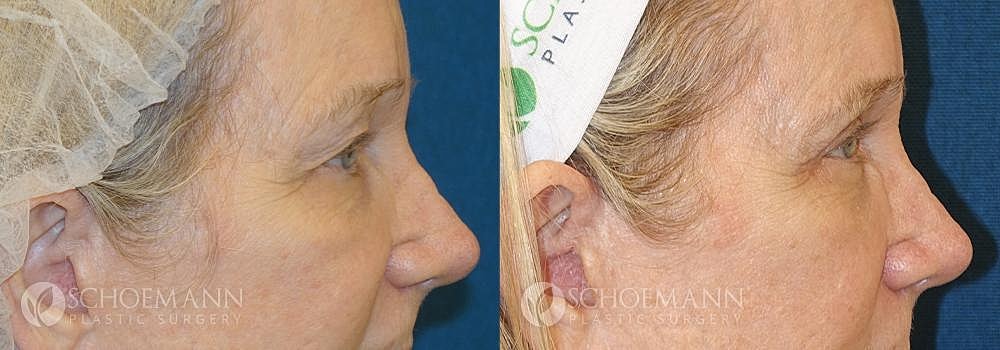 Eyelid Lift Before & After