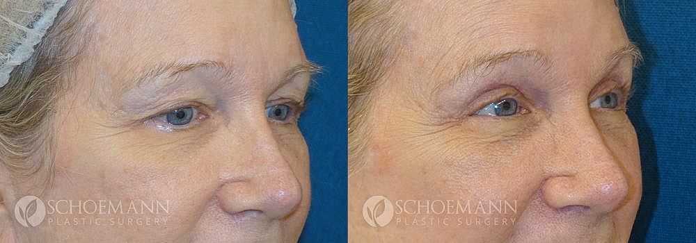 Eyelid Lift Before & After