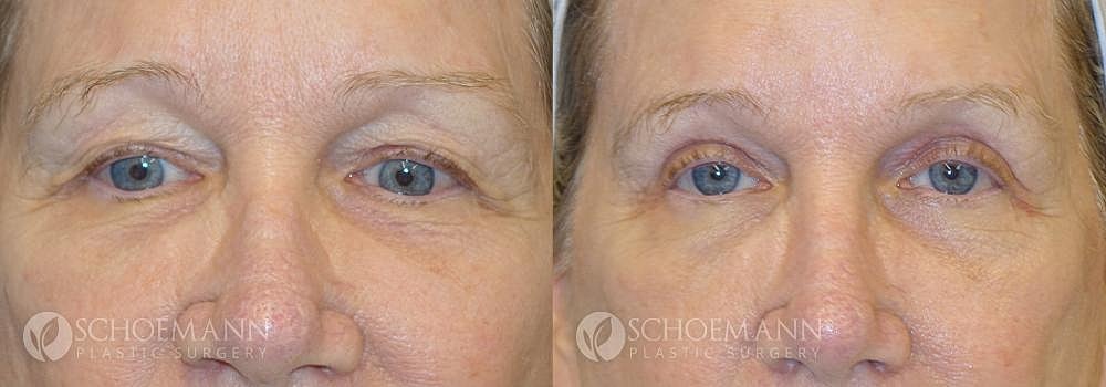 Eyelid Lift Before & After