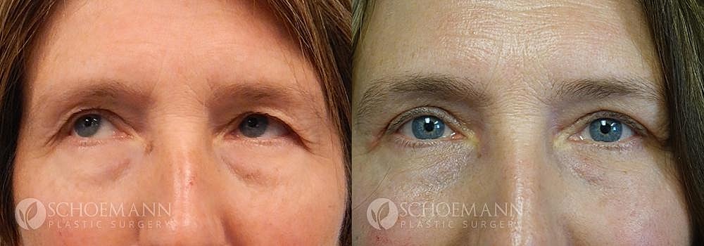Eyelid Lift Before & After