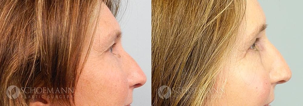 Eyelid Lift Before & After