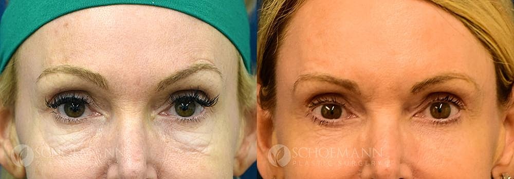 Eyelid Lift Before & After