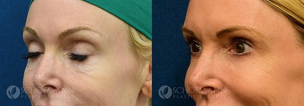 Eyelid Lift Before & After
