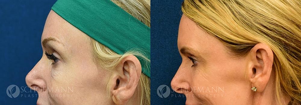 Eyelid Lift Before & After