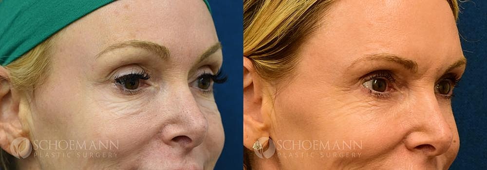 Eyelid Lift Before & After